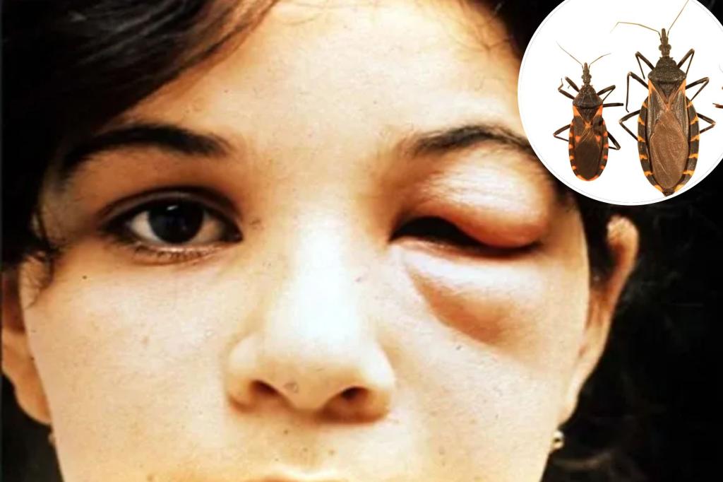 Chagas Disease: 32 US States Report Cases Of Kissing Bug Parasite Infection